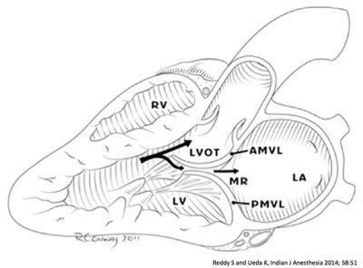 Dynamic left ventricular outflow tract obstruction (LVOTO)